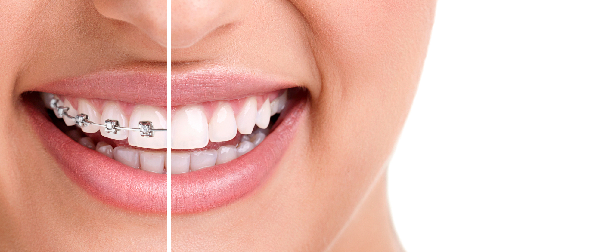 Zobni aparat vam pomaga izbrati ortodont